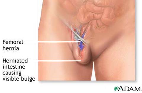 hernia surgery repair women ไส้เลื่อนในผู้หญิง
