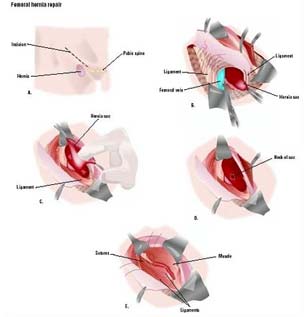hernia surgery repair women ไส้เลื่อนในผู้หญิง